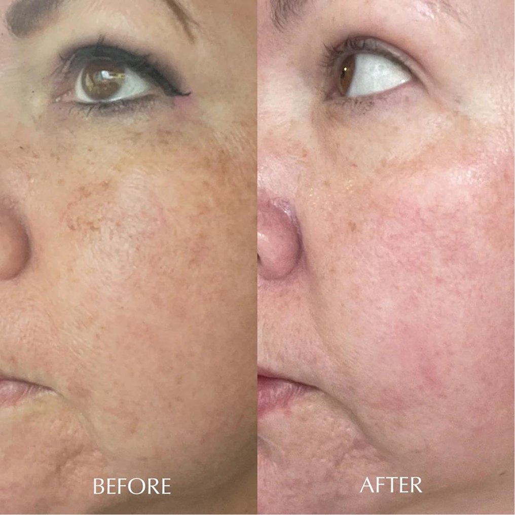 Before and after — 8 weeks